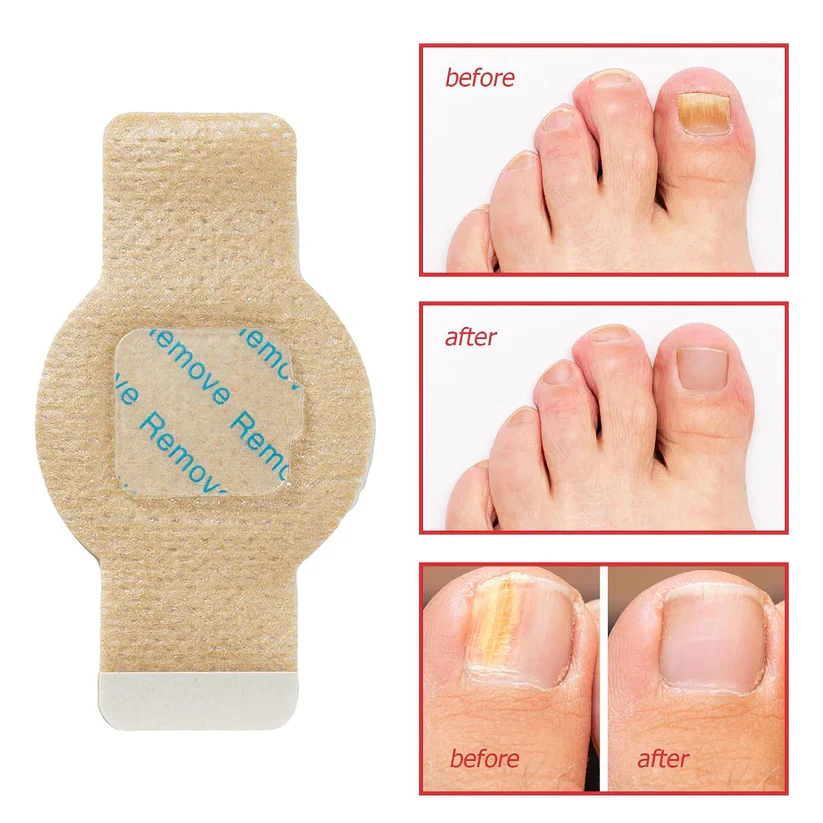 NailHeal™ - Fungal Nail Patches 🌿💅 ( Buy 1 Get 1 Free🔥🔥) - Image 7